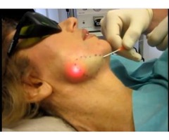 LASER ALQUILER LASER CIRUGIA PLASTICA ESTETICA